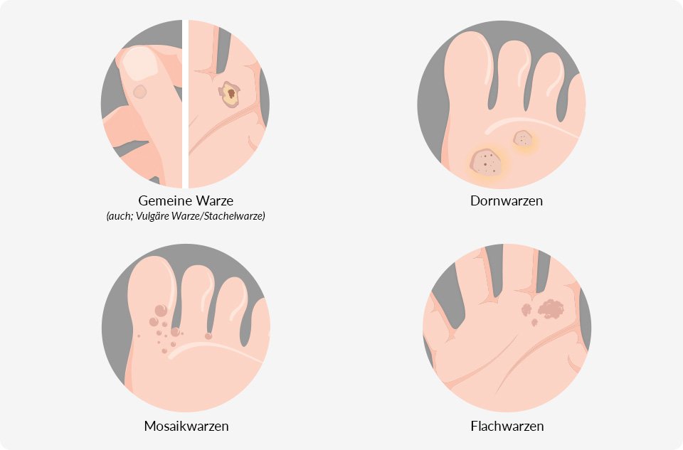 Die Grafik zeigt vulgäre Warzen, Flachwarzen und Stachelwarzen an Händen sowie Dornwarzen und Mosaikwarzen an Füßen.
