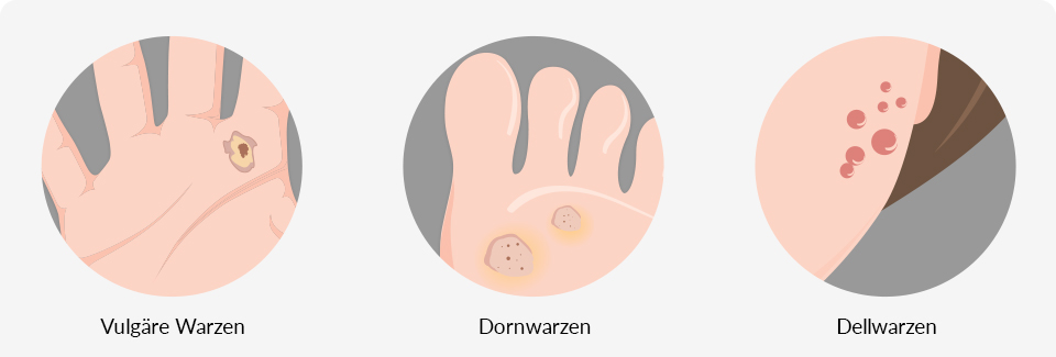 Die Übersichtsgrafik zeigt eine Vulgäre Warze an einer Handinnenfläche, Dornwarzen unter einer Fußsohle sowie Dellwarzen im Gesicht. 