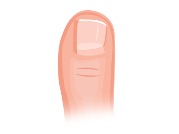 Grafik eines Zehennagels: Beim Fußnagel wurde ein Teil des Nagels, des Nagelwalls und der Nagelwurzel entfernt.