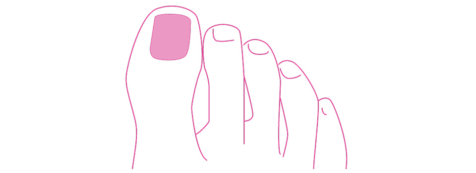 Die Grafik zeigt die Umrisse eines Fußes mit Fokus auf die Zehen und Zehennägel. Ein Zehennagel ist leicht rosa eingefärbt.